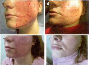 etapy regenerácie kože po procedúre frakčnej ablácie