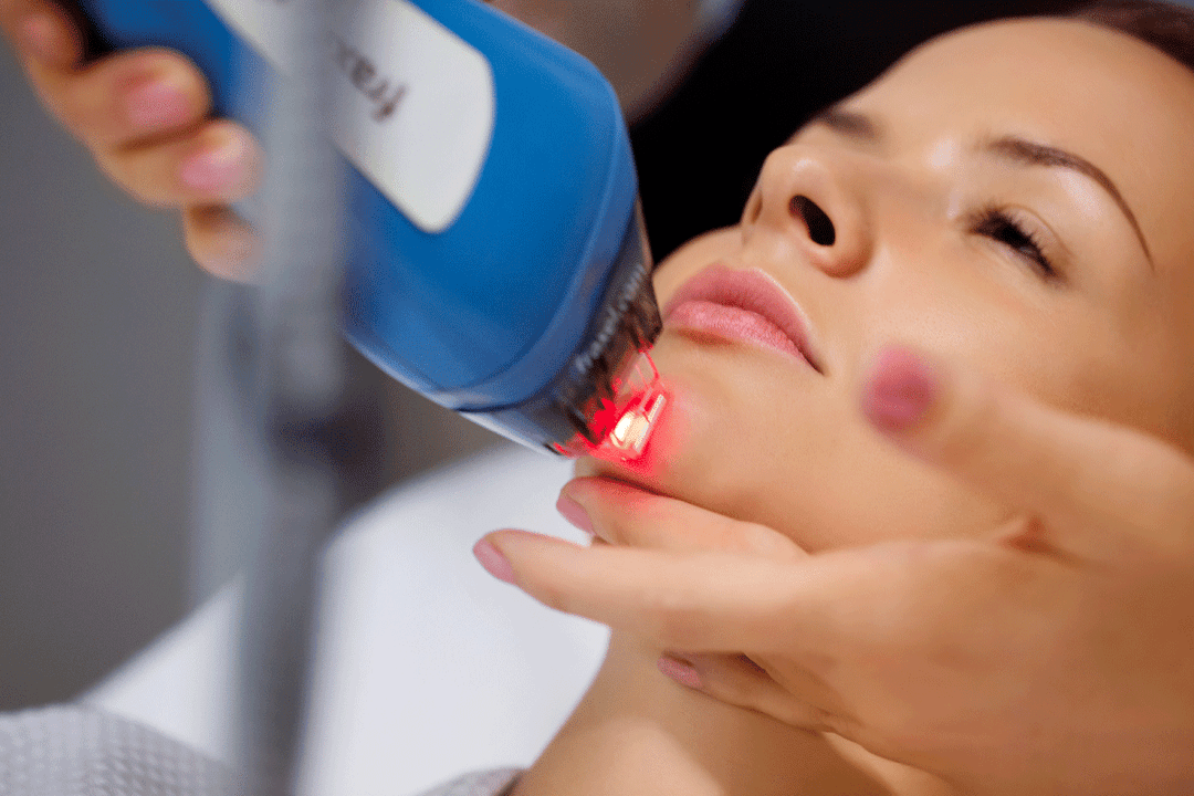 laserové omladenie pokožky tváre