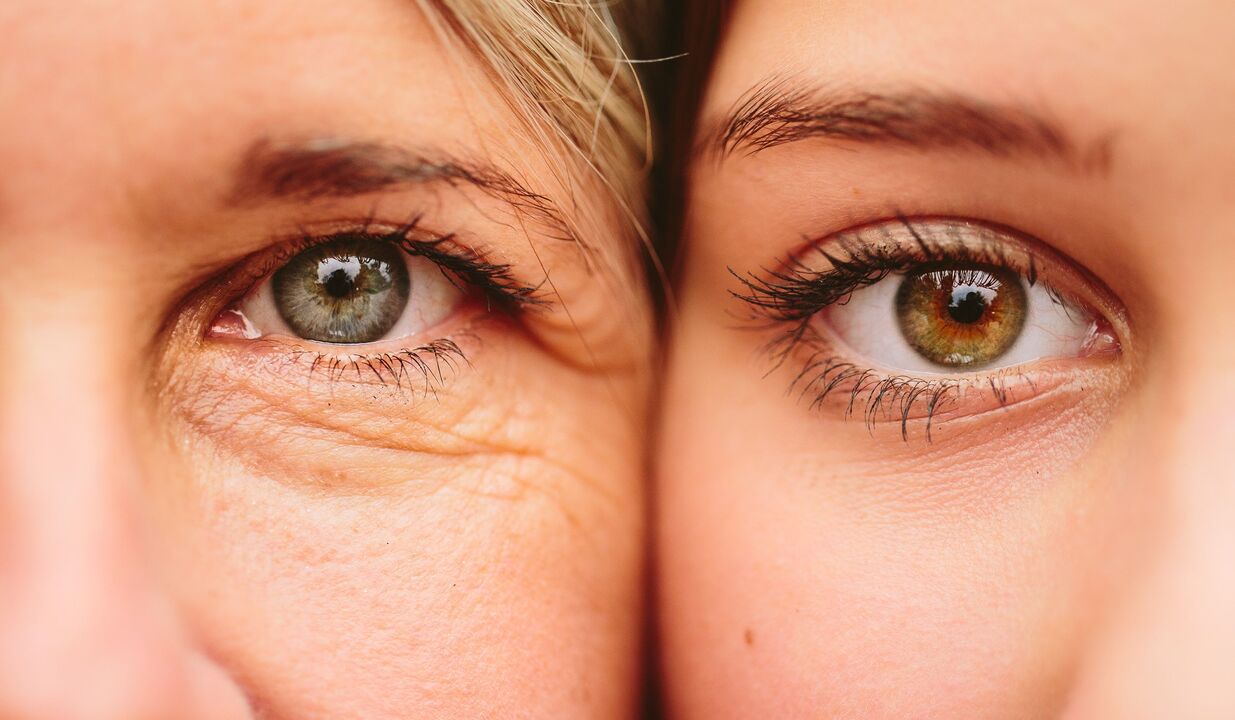 známky starnutia okolo očí