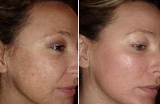 laserové omladenie pokožky tváre pred a po fotografiách